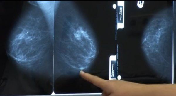 Egészségfelmérés, mammográfiával